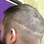 Hair Transplant Scar  Scalp Stippling