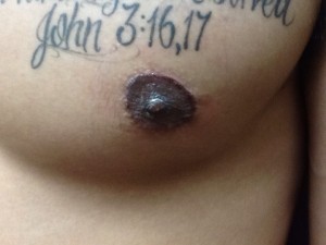 Areola Restoration  Right After