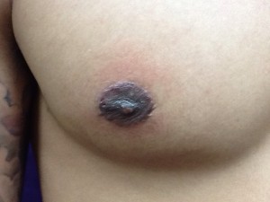 Areola Restoration Right After