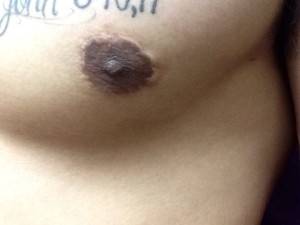 Areola Reduction Scar Male Before Restoration
